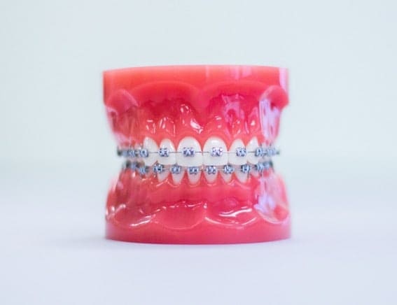 Traditional Braces at Henseler & Kocian Orthodontics